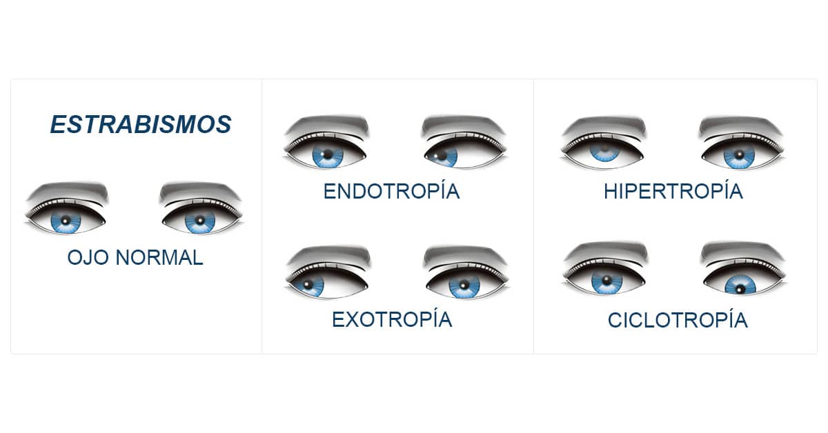 Lentes prismaticos sales para estrabismo