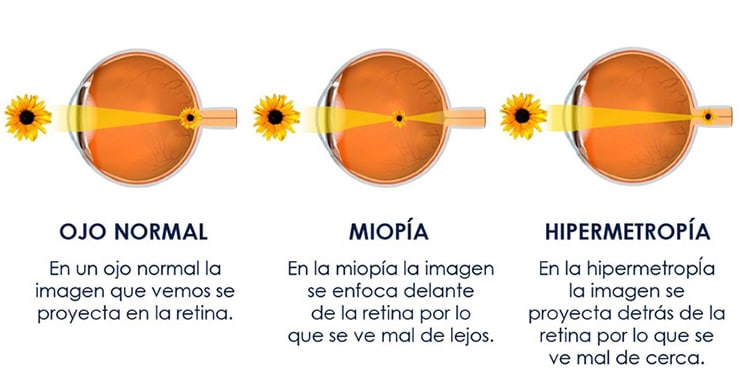 Deficiențe vizuale: Ce este Miopia și cum o tratăm?