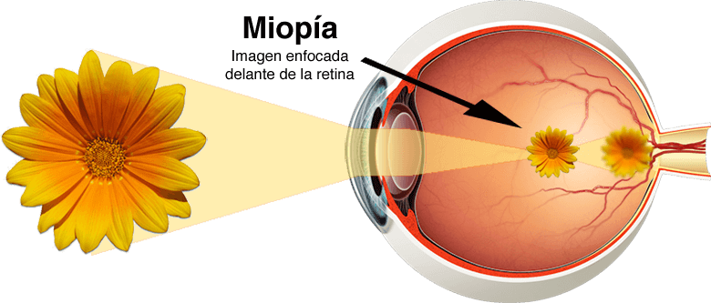 Miopia și soluțiile de corecție optică