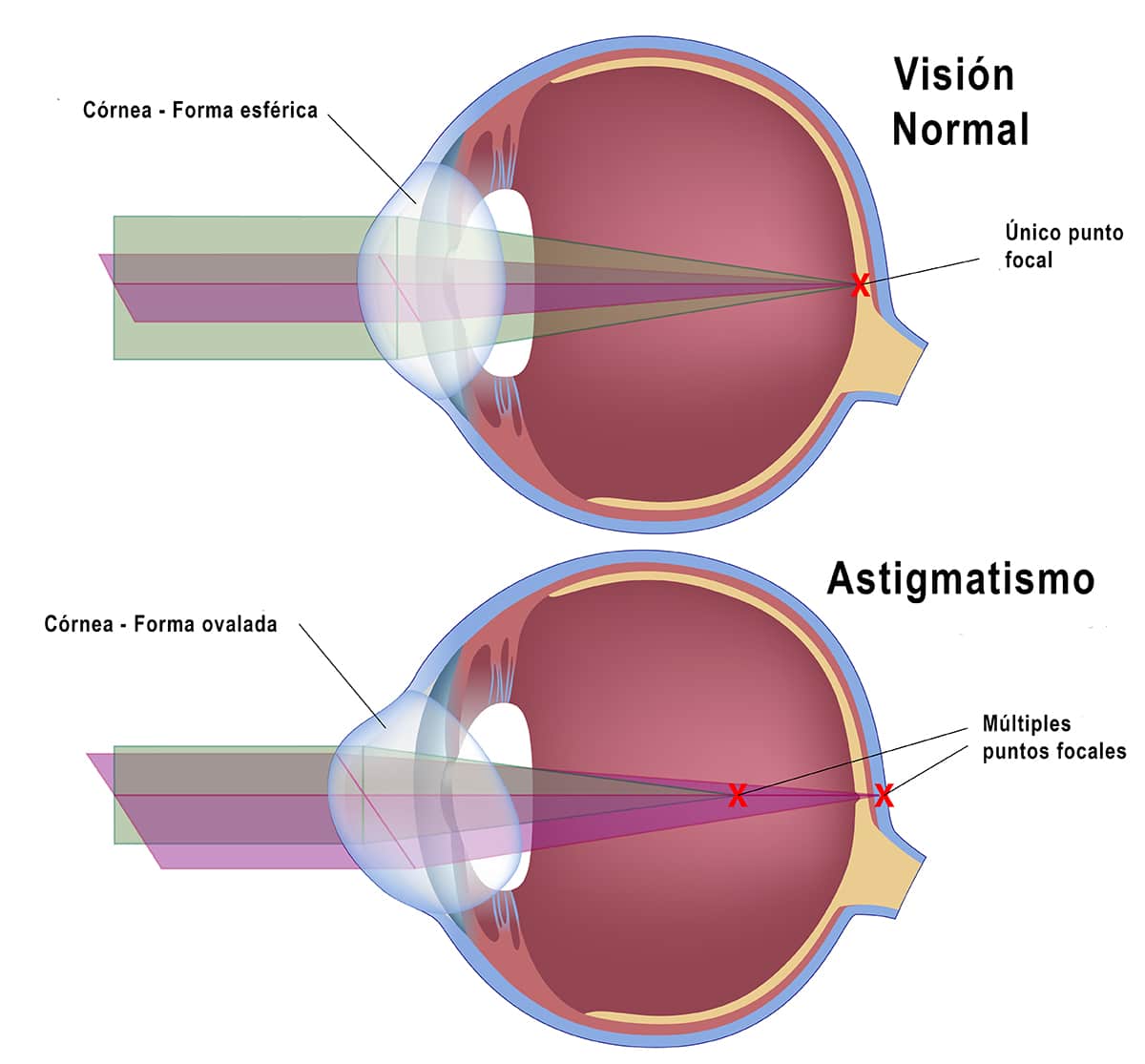 stigmatism vizual miopia ochiului de gimnastică pentru ochi