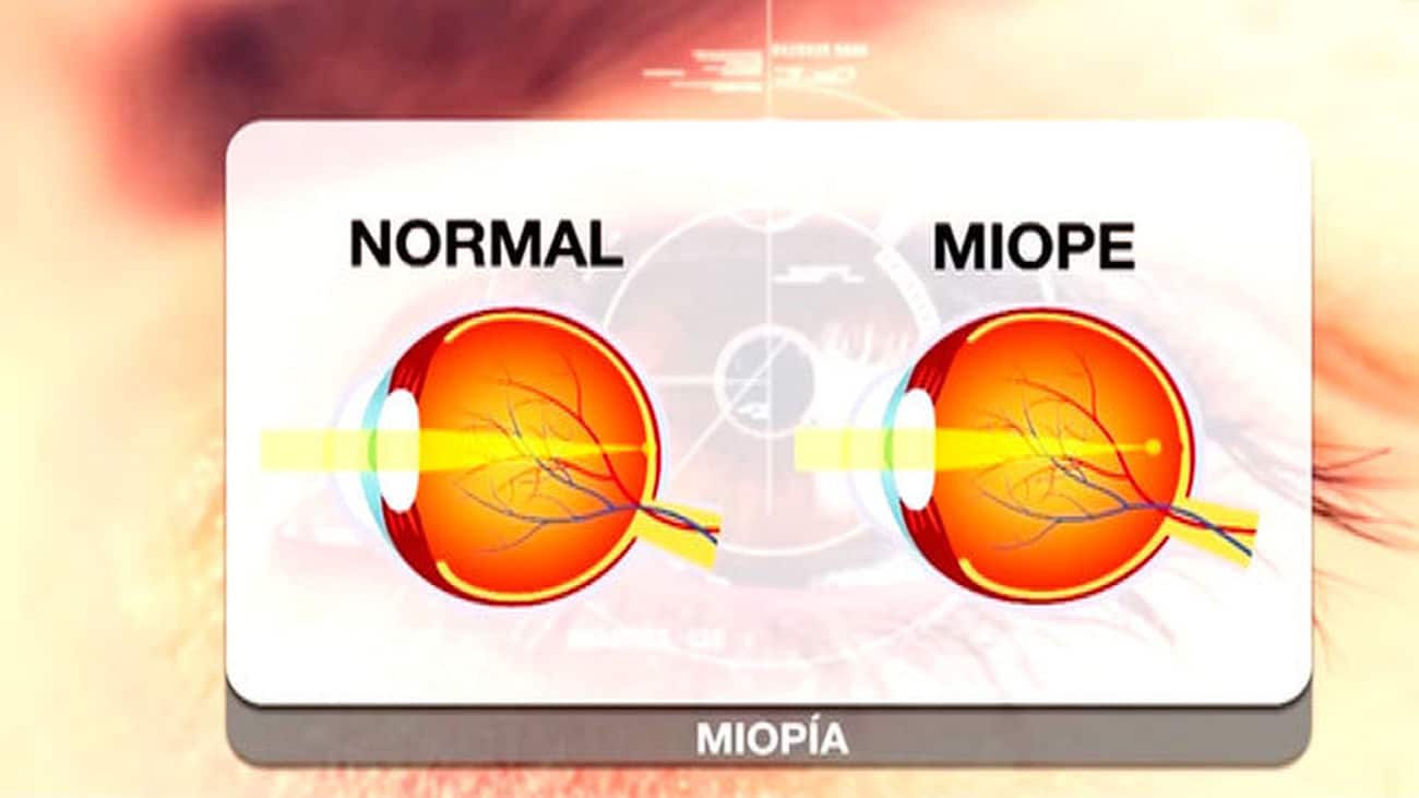 cum este definită miopia caracteristici ale senzației cu insuficiență vizuală