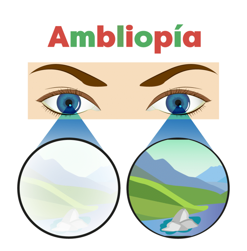 ambliopía y terapia visual