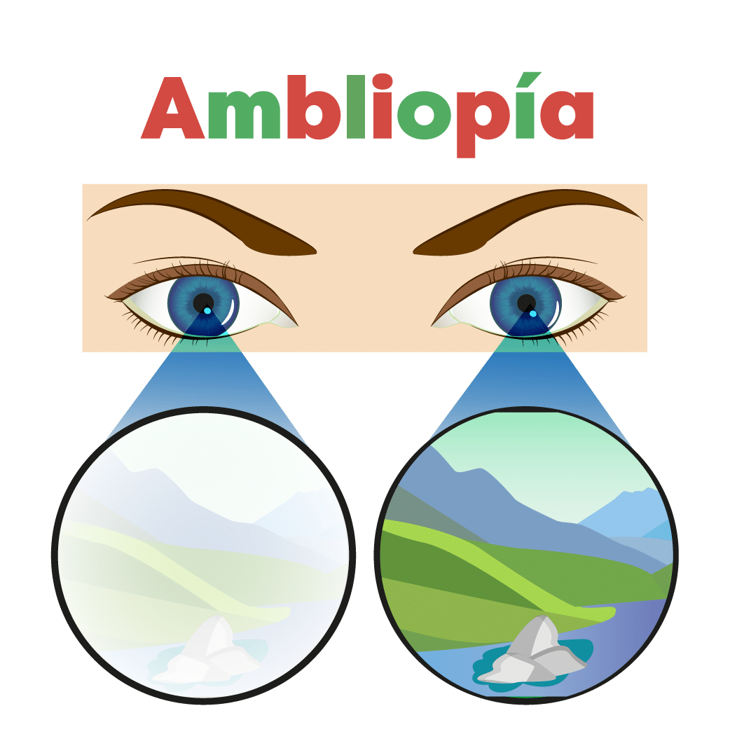 ambliopía y terapia visual